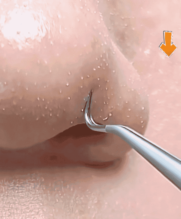 3‑Piece Professional Blackhead Tweezers Kit – Stainless Steel Acne & Pimple Extractor with Storage Box | Facial Skincare Tools